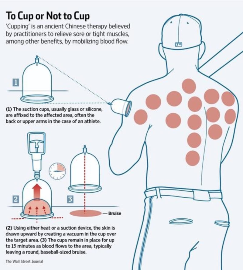 MASSAGE MONDAY Cupping explained PHYXIT Physio and Injury Clinic